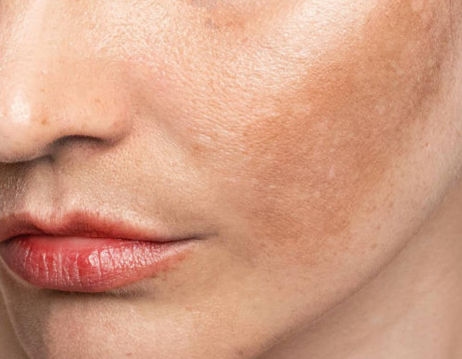 Decode Your Glow: Mengenal Jenis Flek di Wajah & Solusi Ilmiah di Baliknya