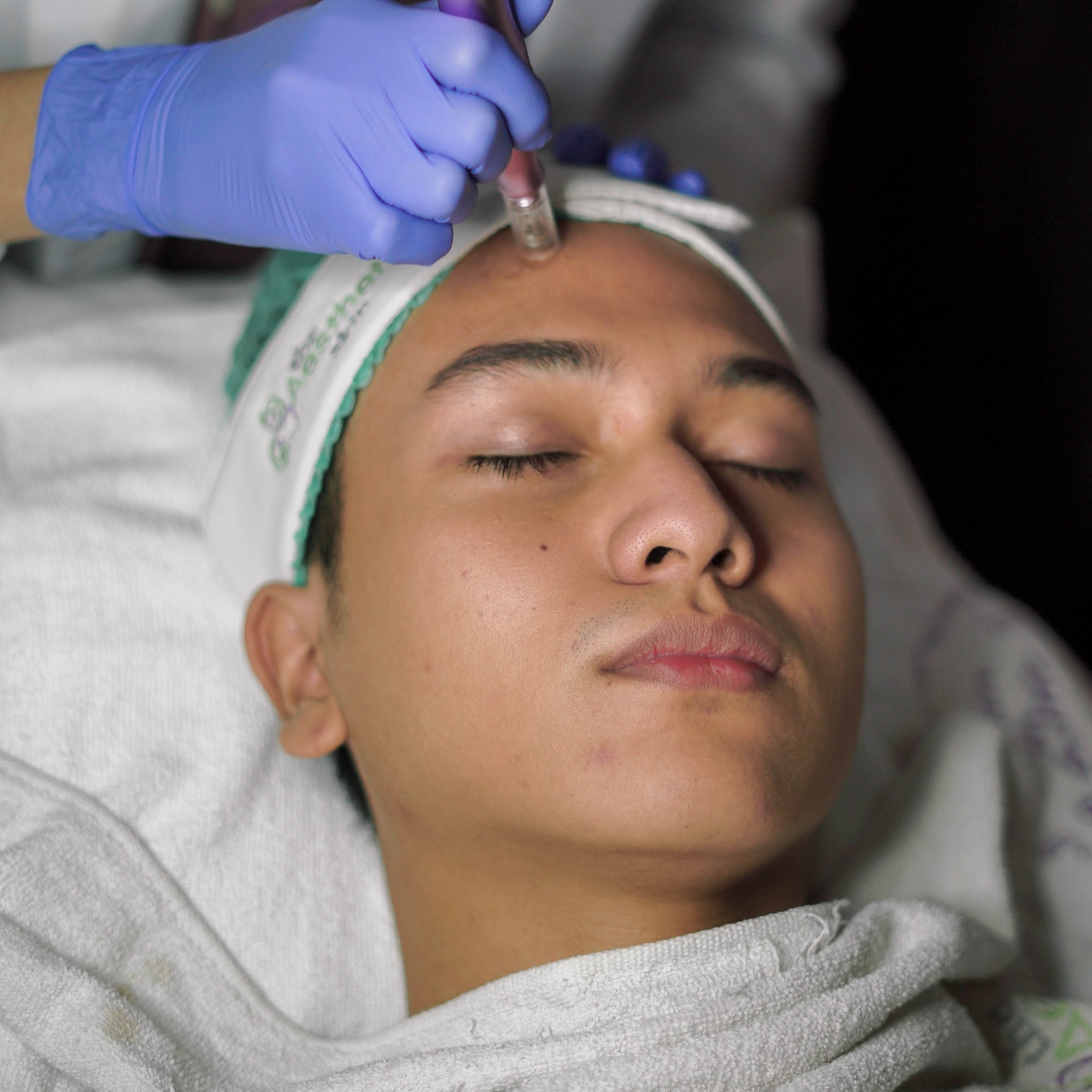 Manfaat Tindakan Microneedling untuk Kesehatan dan Kecantikan Kulit
