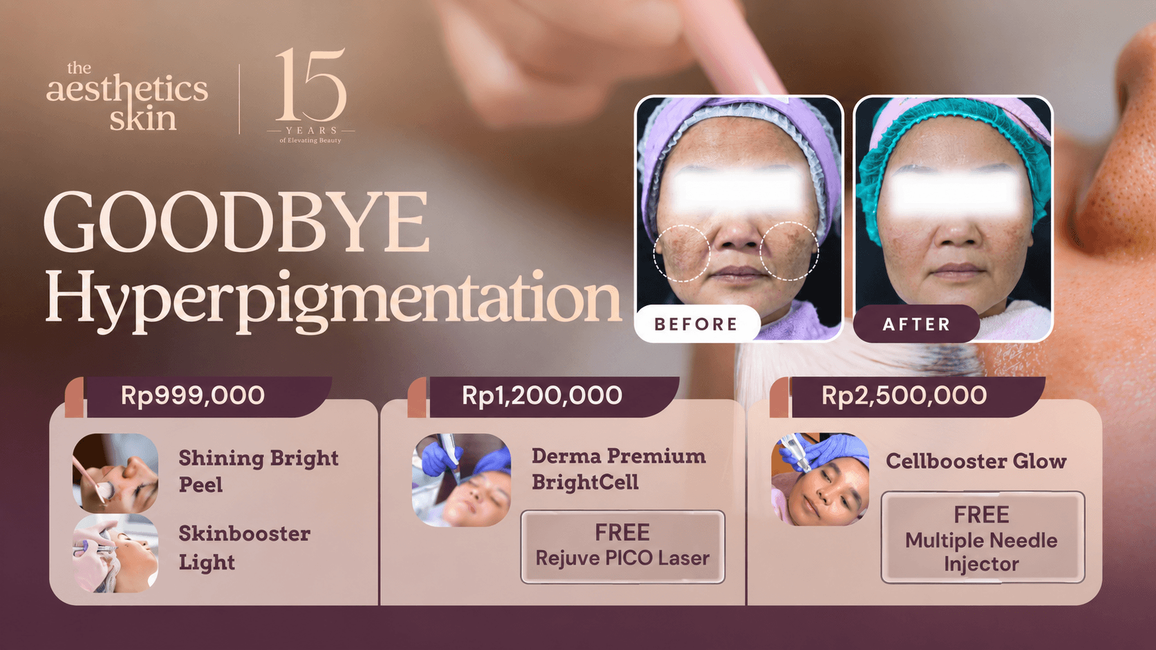 Goodbye Hyperpigmentation The Aesthetics Skin