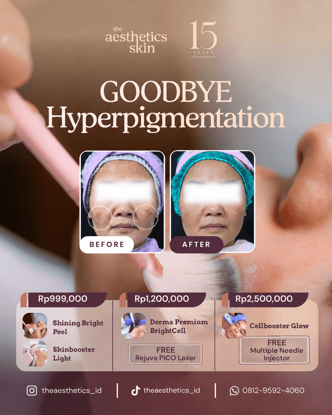Goodbye Hyperpigmentation The Aesthetics Skin